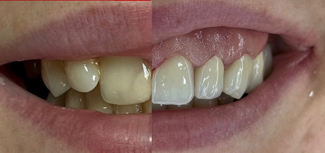 Înainte și după estetică dentară frontală