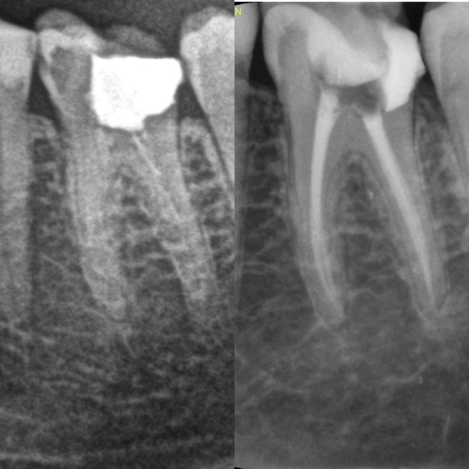 Radiografie înainte și după tratament endodontic — caz tratat la cabinetul Doctor Elkataa
