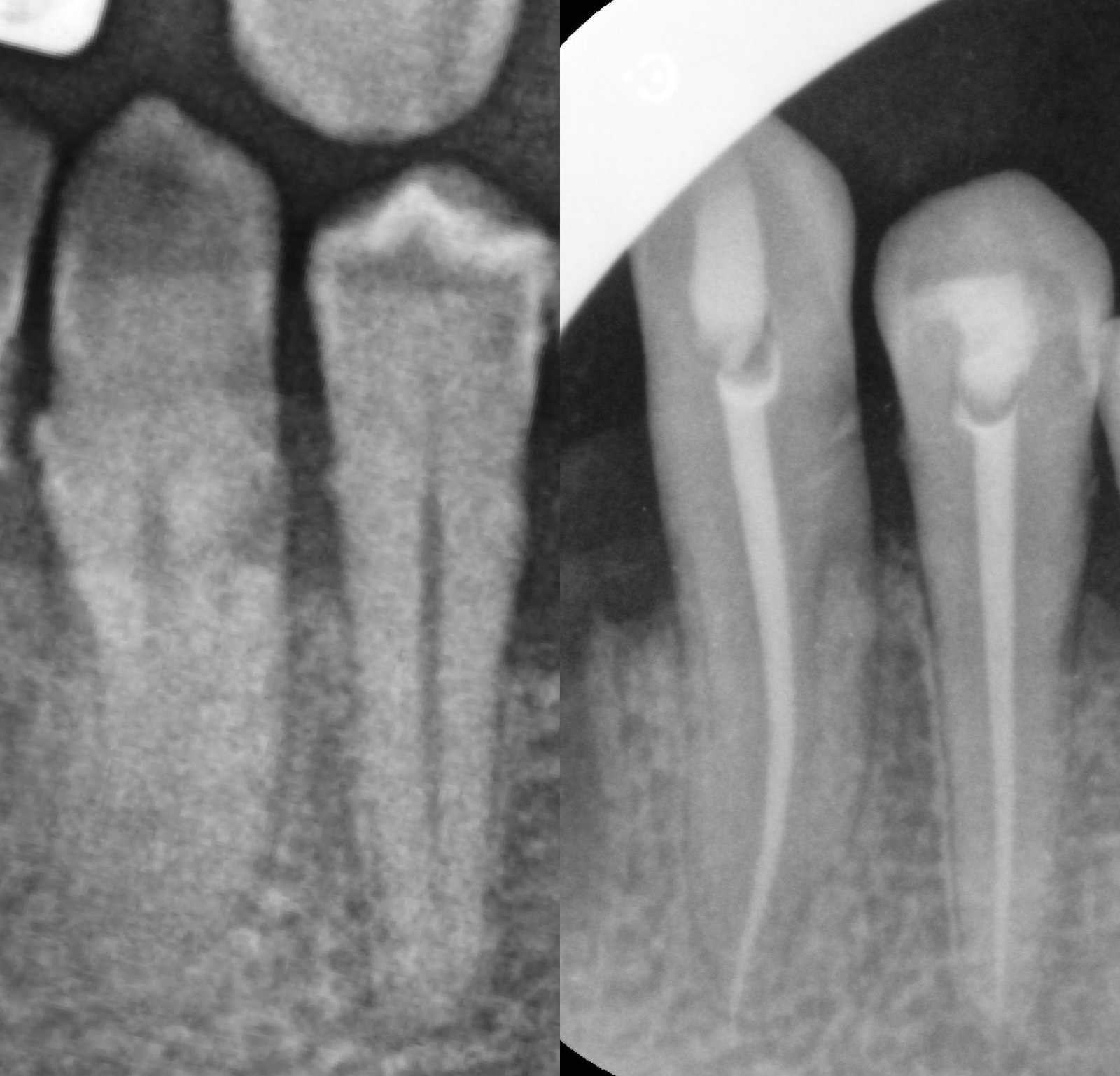 Radiografii înainte și după tratament endodontic — caz 2